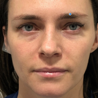 Fat Transfer to Face Before Image 1